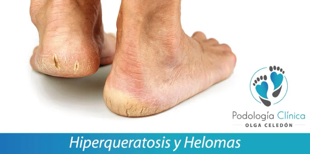 Hiperqueratosis y Helomas